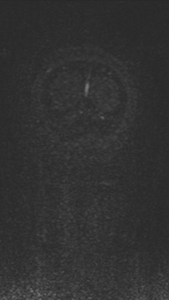 Normal MRI brain with MRV- teenager (Radiopaedia 49425-54553 Coronal MRV 219).jpg