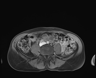 Normal adrenal glands MRI (Radiopaedia 82017-96004 M 71).jpg