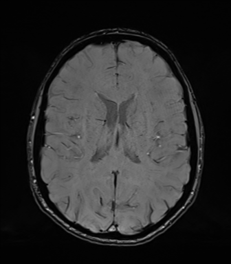 Normal brain MRI (TLE protocol) (Radiopaedia 40748-43405 Axial SWI 52).png