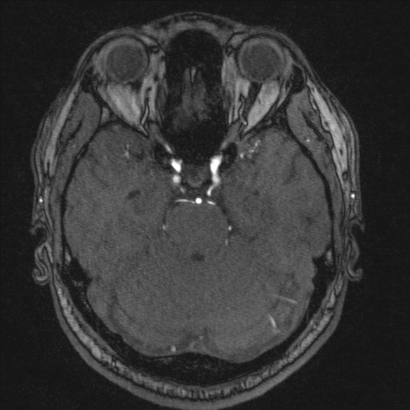 Normal brain MRI including MRA (Radiopaedia 48748-53763 Axial MRA 69).jpg
