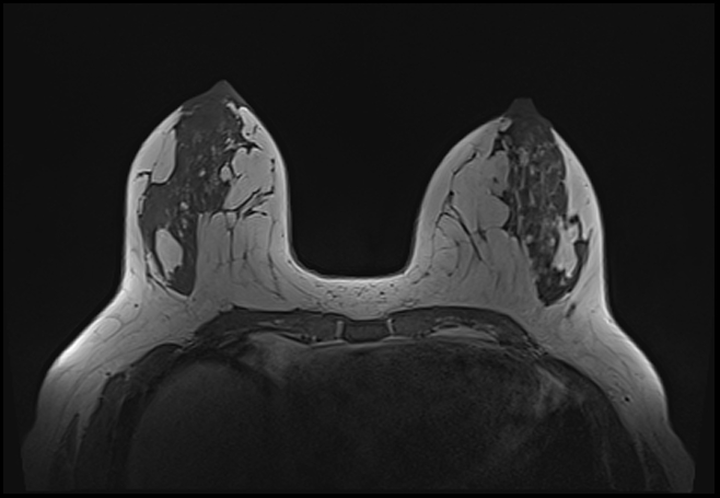 File:Normal breast MRI - dense breasts (Radiopaedia 80454-93850 Axial T1 91).jpg