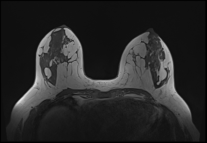 File:Normal breast MRI - dense breasts (Radiopaedia 80454-93850 Axial T1 95).jpg