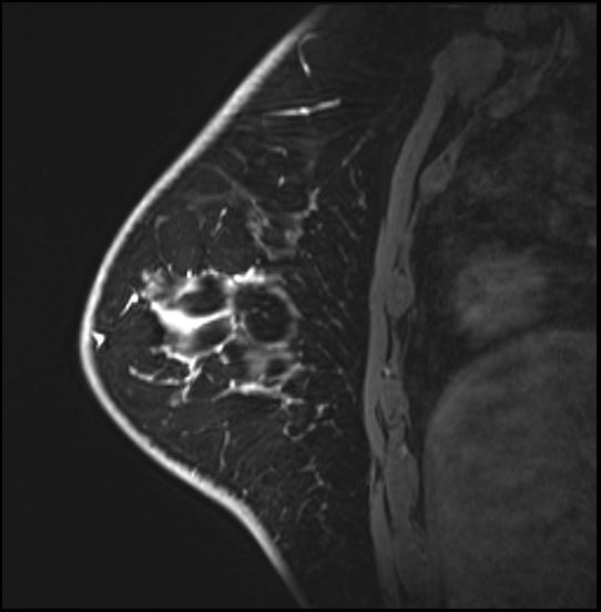 Normal breast MRI - dense breasts (Radiopaedia 80454-93850 I 137).jpg