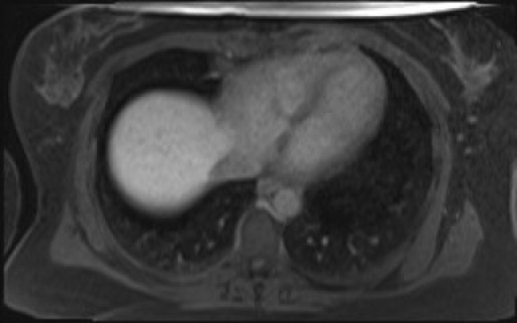 File:Normal hepatobiliary phase liver MRI (Radiopaedia 58968-66230 A 12).jpg