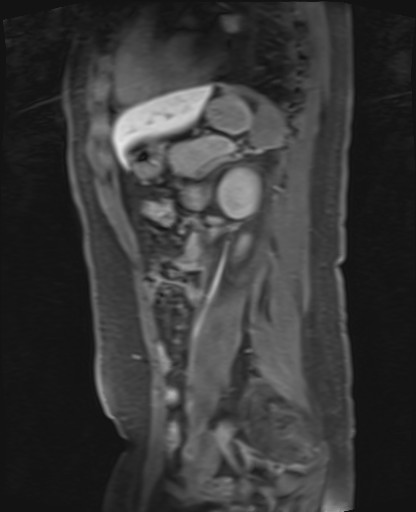 File:Normal hepatobiliary phase liver MRI (Radiopaedia 58968-66230 C 52).jpg