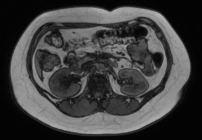 File:Normal liver MRI with Gadolinium (Radiopaedia 58913-66163 B 13).jpg