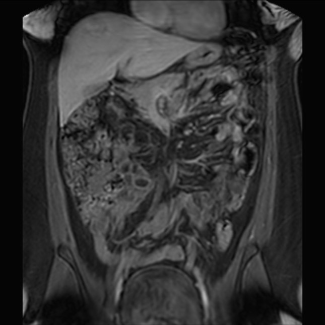 Normal liver MRI with Gadolinium (Radiopaedia 58913-66163 P 36).jpg