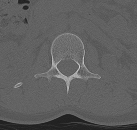 File:Normal lumbar spine CT (Radiopaedia 46533-50986 Axial bone window 12).png