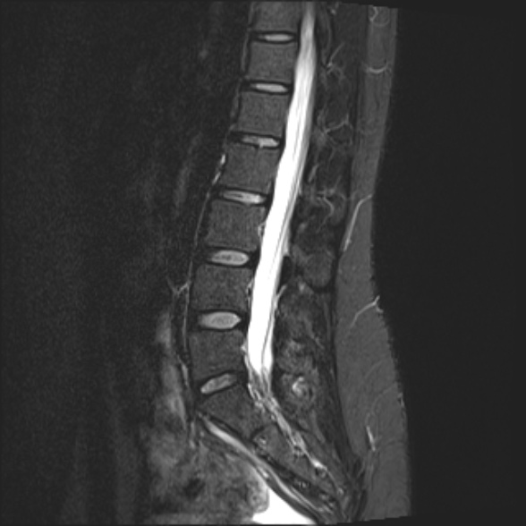 File:Normal lumbar spine MRI- 3 T (Radiopaedia 53280-59250 Sagittal STIR 15).jpg