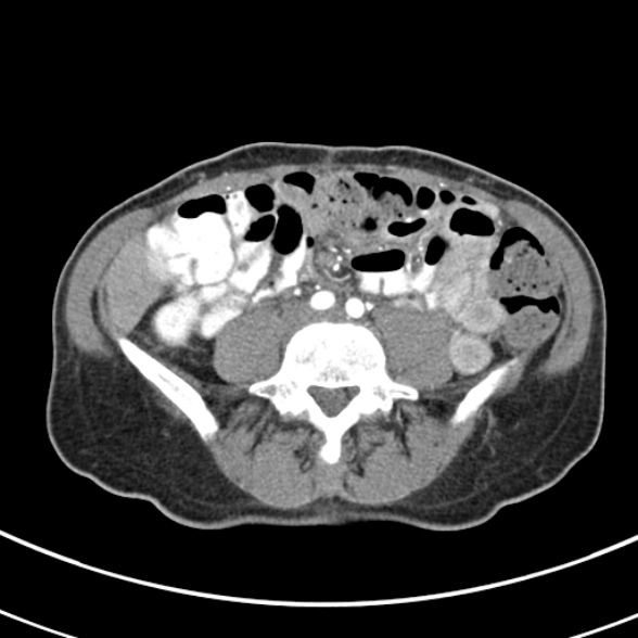 File:Normal multiphase CT liver (Radiopaedia 38026-39996 B 56).jpg