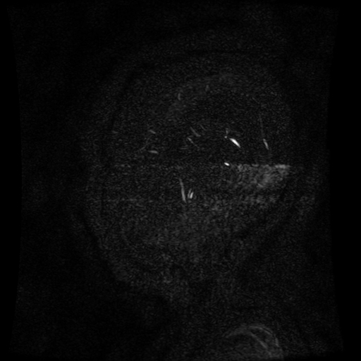 Normal noncontrast MR venography (Radiopaedia 87578-103957 A 7).jpg