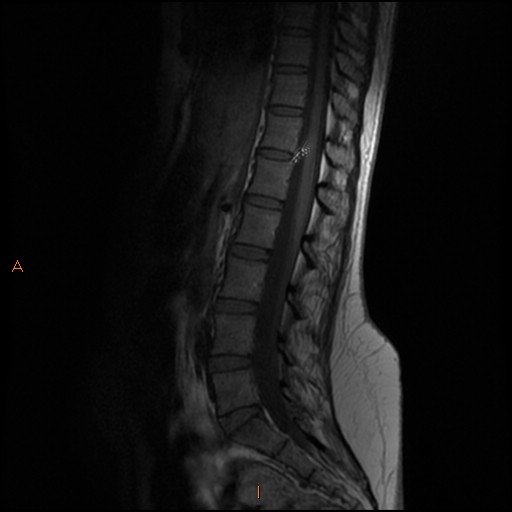 File:Normal spine MRI (Radiopaedia 77323-89408 Sagittal T1 7).jpg