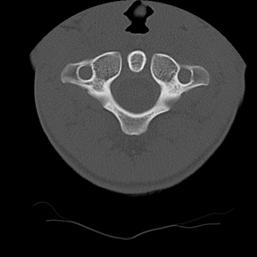 File:Normal trauma spine imaging (age 16) (Radiopaedia 45335-49358 Axial bone window 12).jpg