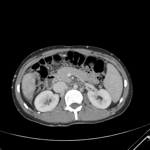 File:Nutmeg liver- Budd-Chiari syndrome (Radiopaedia 46234-50635 B 25).png