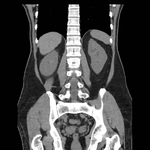 File:Obstructed kidney with perinephric urinoma (Radiopaedia 26889-27067 Coronal non-contrast 21).jpg