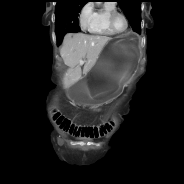 Obstructed obturator hernia (Radiopaedia 75197-86293 B 11).jpg