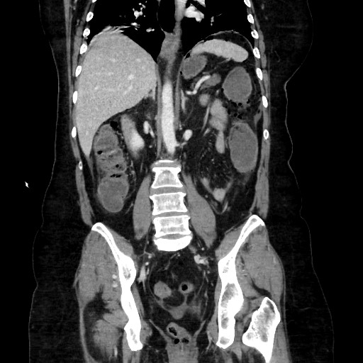 Obstructive distal colonic adenocarcinoma causing cecal perforation (Radiopaedia 86830-102989 C 112).jpg