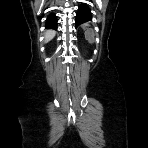 Obstructive distal colonic adenocarcinoma causing cecal perforation (Radiopaedia 86830-102989 C 144).jpg