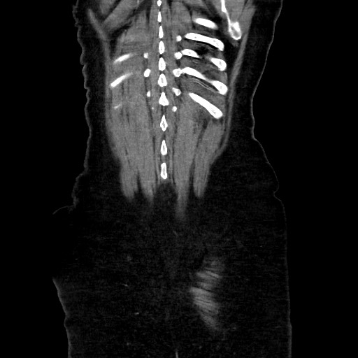 Obstructive distal colonic adenocarcinoma causing cecal perforation (Radiopaedia 86830-102989 C 151).jpg