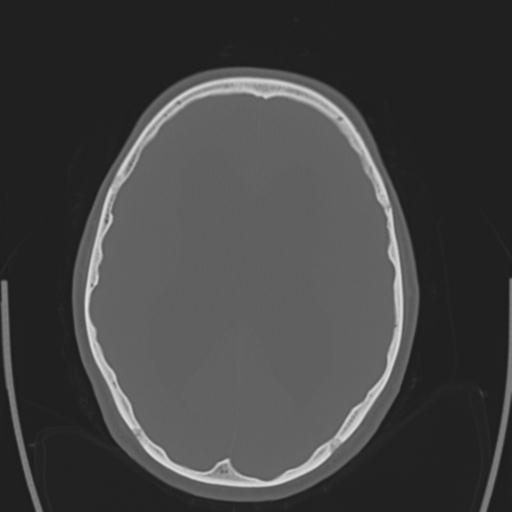 File:Obstructive hydrocephalus (Radiopaedia 30453-31119 Axial bone window 14).jpg