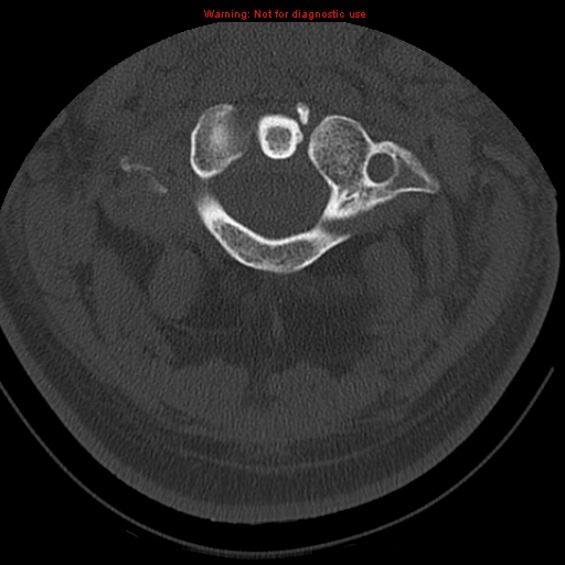 File:Occipital condyle fracture (Radiopaedia 18366-18208 Axial bone window 19).jpg