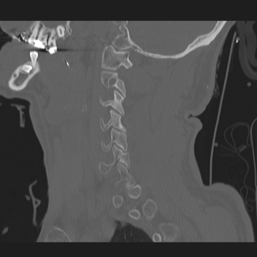 File:Occipital condyle fracture (Radiopaedia 33467-34517 Sagittal bone window 20).png