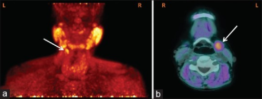 a, b)Choline photon emission tomography/computed tomography image shows the ectopic left superior parathyroid adenoma with intense uptake