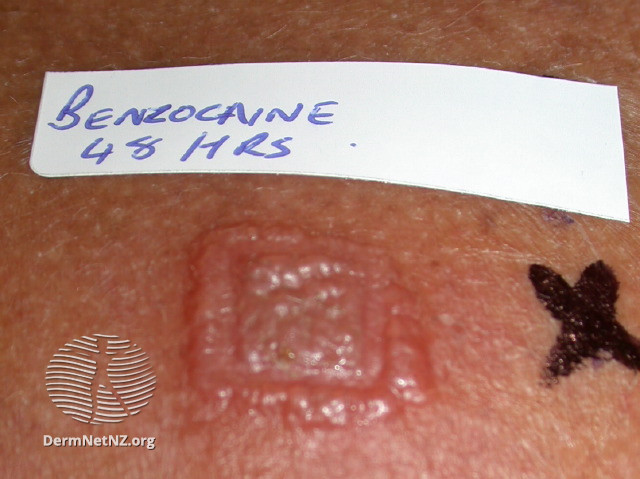 File:Positive patch test to benzocaine (DermNet NZ benzocaine-patch).jpg