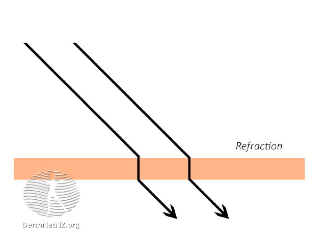 File:Refraction of light (DermNet NZ refraction).jpg