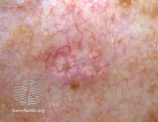 File:Sebaceous hyperplasia dermoscopy (DermNet NZ TAUR15031).jpg