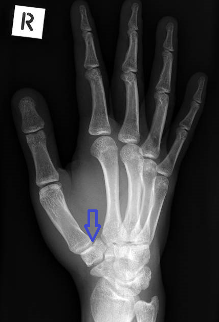 Trapezium fracture - WikiProjectMed