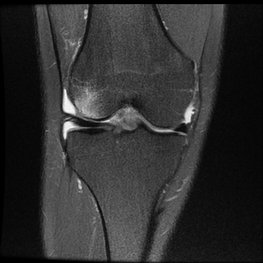 File:ACL acute full thickness tear - deep lateral femoral sulcus sign (Radiopaedia 38594-40740 Coronal PD fat sat 10).jpg