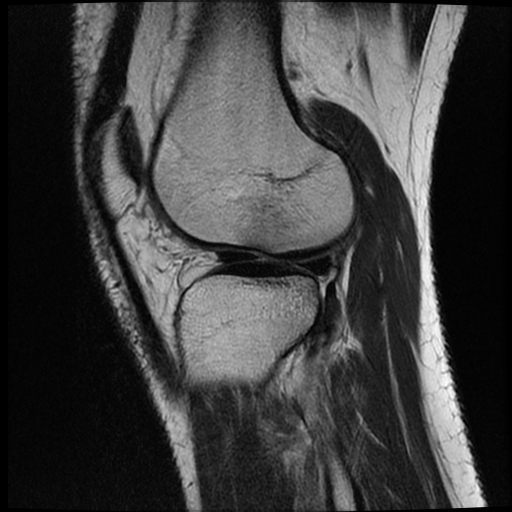 File:ACL acute full thickness tear - deep lateral femoral sulcus sign (Radiopaedia 38594-40740 Sagittal T2 16).jpg