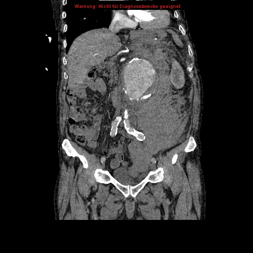 Abdominal aortic aneurysm- extremely large, ruptured (Radiopaedia 19882-19921 Coronal C+ arterial phase 48).jpg