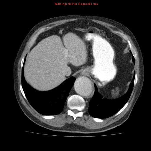 Abdominal aortic aneurysm (Radiopaedia 10122-10660 Axial C+ portal venous phase 12).jpg