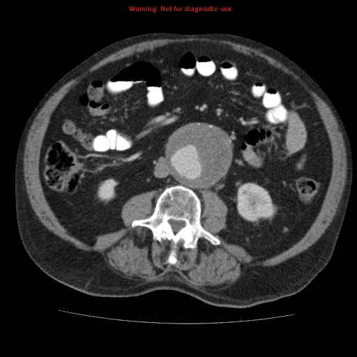Abdominal aortic aneurysm (Radiopaedia 10122-10660 Axial C+ portal venous phase 42).jpg