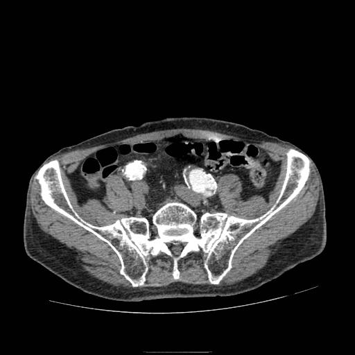File:Abdominal aortic aneurysm (Radiopaedia 13341-13340 Axial C+ arterial phase 179).jpg