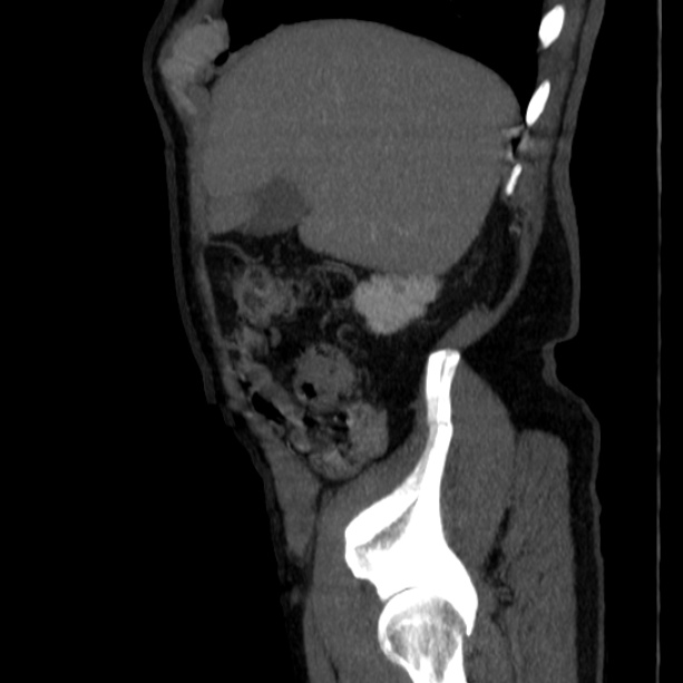 Abdominal aortic aneurysm (Radiopaedia 29248-29660 Sagittal C+ arterial phase 9).jpg