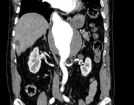 Abdominal aortic aneurysm (Radiopaedia 67117-76452 Coronal C+ arterial phase 52).jpg