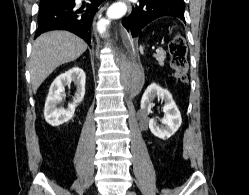 File:Abdominal aortic aneurysm (Radiopaedia 67117-76452 Coronal C+ arterial phase 70).jpg