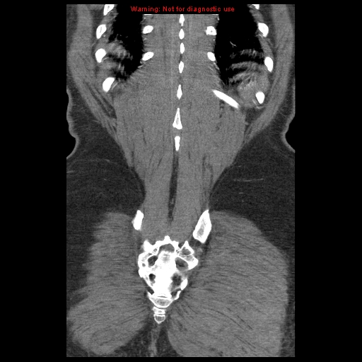 Abdominal aortic aneurysm (Radiopaedia 8190-9038 Coronal C+ arterial phase 116).jpg
