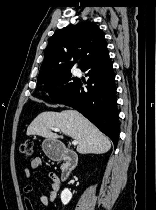 Abdominal aortic aneurysm (Radiopaedia 83094-97462 Sagittal renal cortical phase 47).jpg