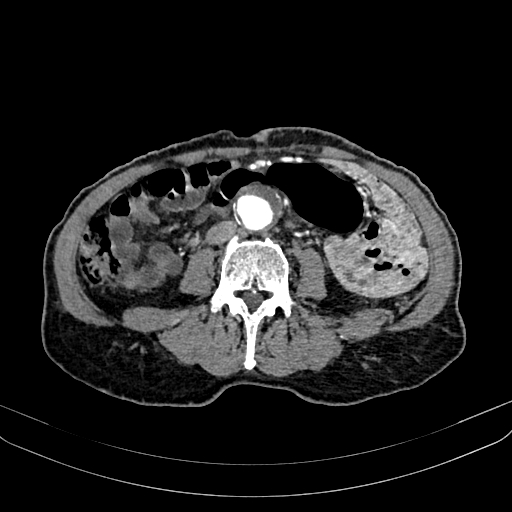 File:Abdominal aortic aneurysm (Radiopaedia 83581-98689 Axial C+ arterial phase 68).jpg