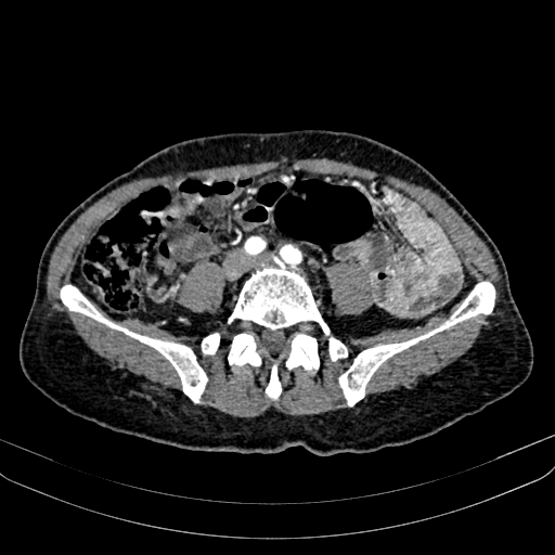Abdominal aortic aneurysm (Radiopaedia 83581-98689 Axial C+ arterial phase 78).jpg
