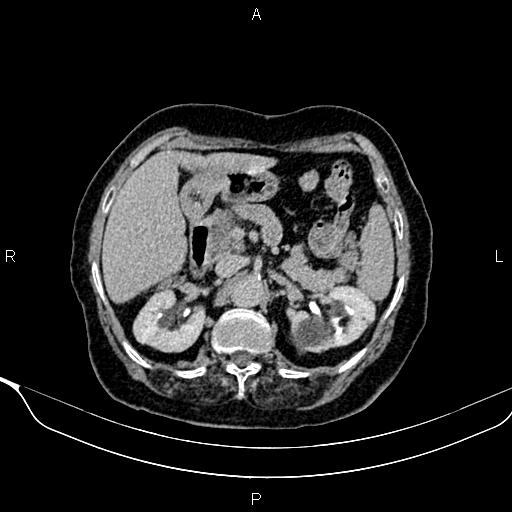 Abdominal aortic aneurysm (Radiopaedia 85063-100606 Axial C+ delayed 29).jpg