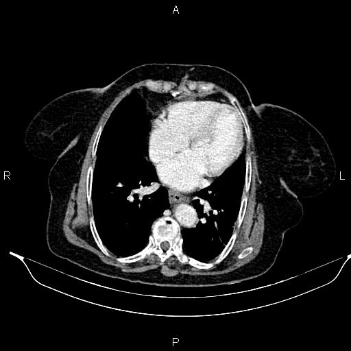 File:Abdominal aortic aneurysm (Radiopaedia 85063-100606 Axial C+ portal venous phase 23).jpg