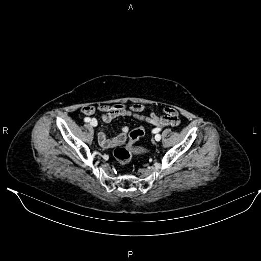 File:Abdominal aortic aneurysm (Radiopaedia 85063-100606 Axial C+ portal venous phase 58).jpg