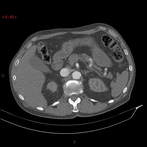 Abdominal aortic aneurysm rupture with aortocaval fistula (Radiopaedia 14897-14841 Axial C+ arterial phase 90).jpg
