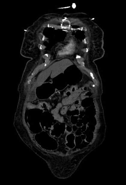 Abdominal aortic aneurysm with thrombus fissuration (Radiopaedia 73192-83919 Coronal C+ arterial phase 2).jpg