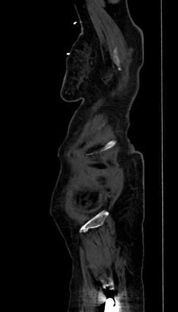 Abdominal aortic aneurysm with thrombus fissuration (Radiopaedia 73192-83919 Sagittal C+ arterial phase 137).jpg
